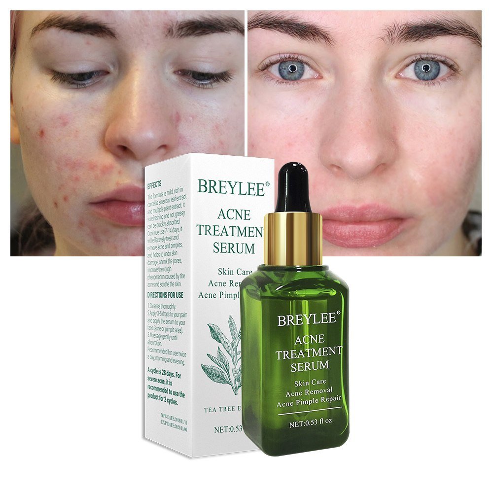BREYLEE facial acne treatment serum with botanical extracts