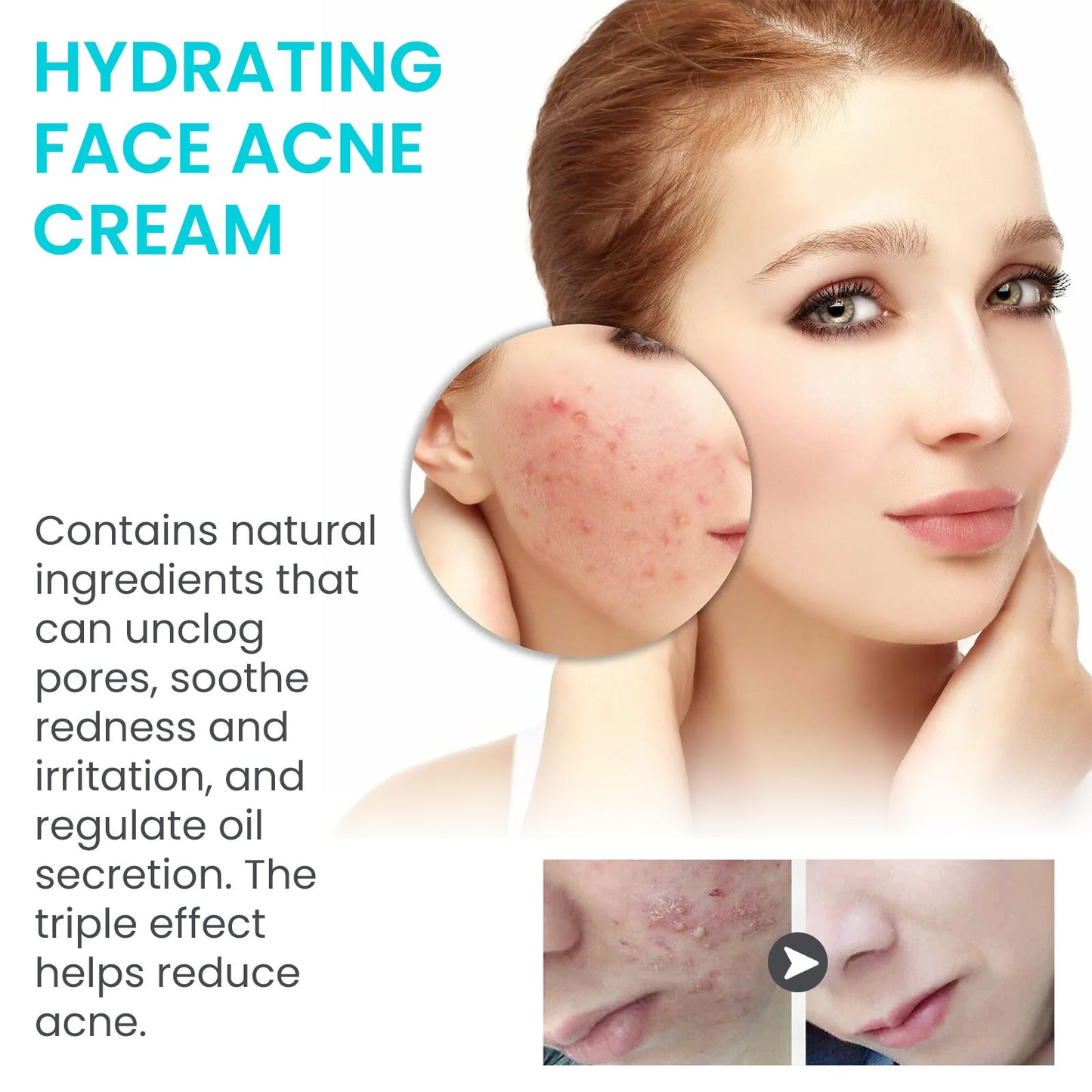 Jaysuing Brightening Acne Cream for Smooth Skin - Elite Nutrition