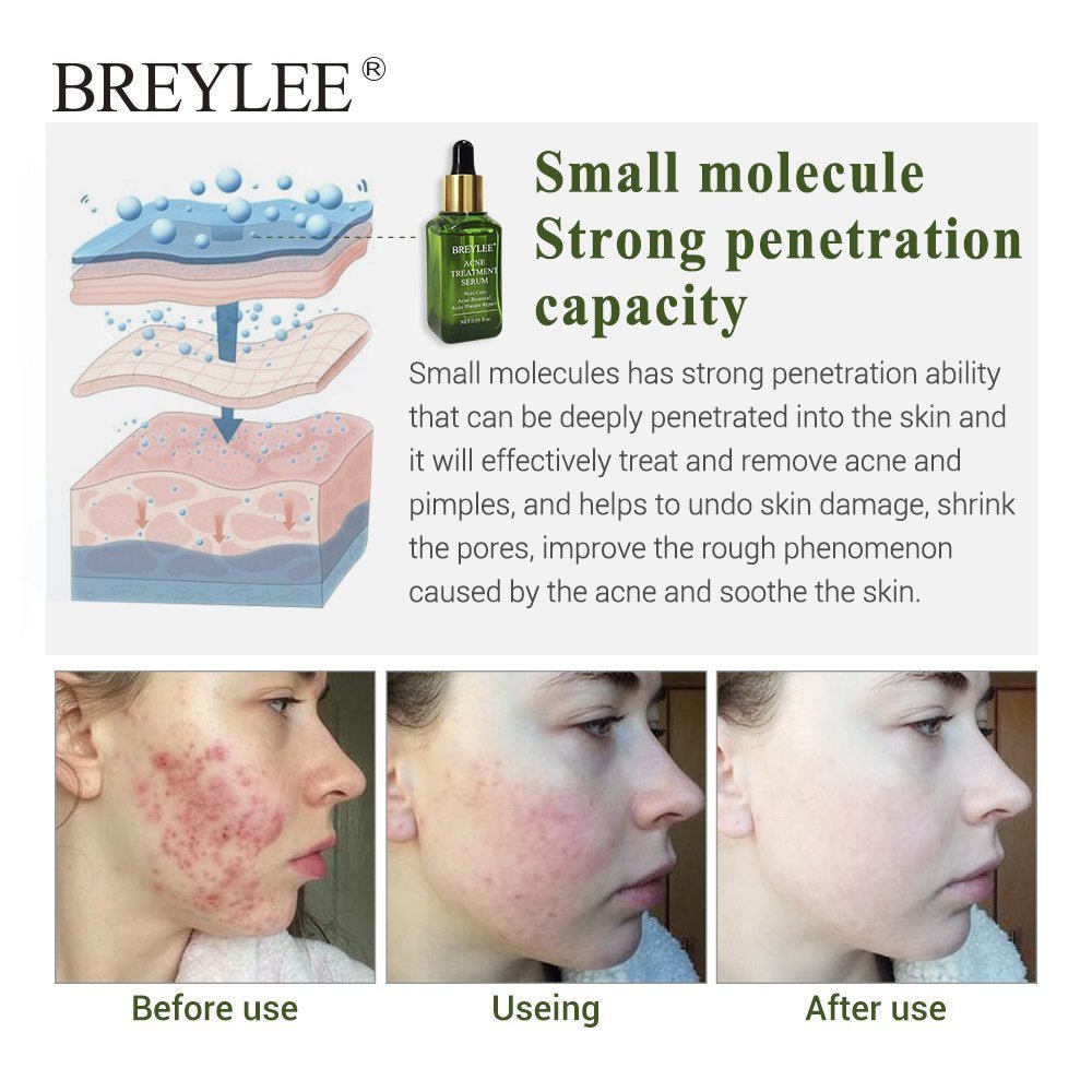 BREYLEE acne treatment serum bottle and packaging