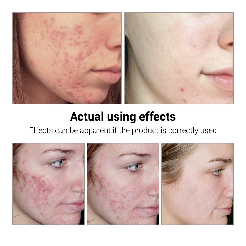 BREYLEE serum for acne marks and uneven-looking skin