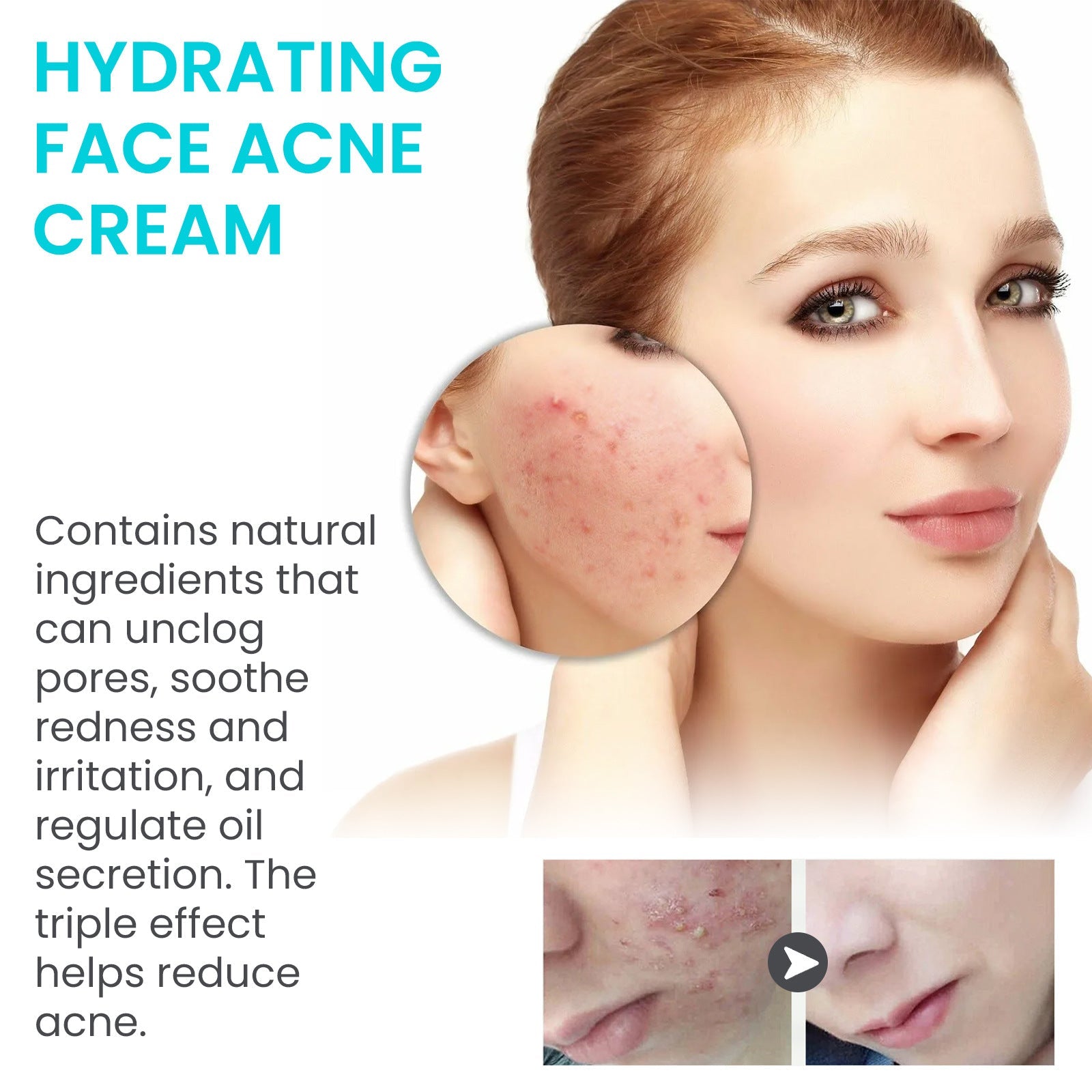 Jaysuing Brightening Acne Cream for Smooth Skin - Elite Nutrition