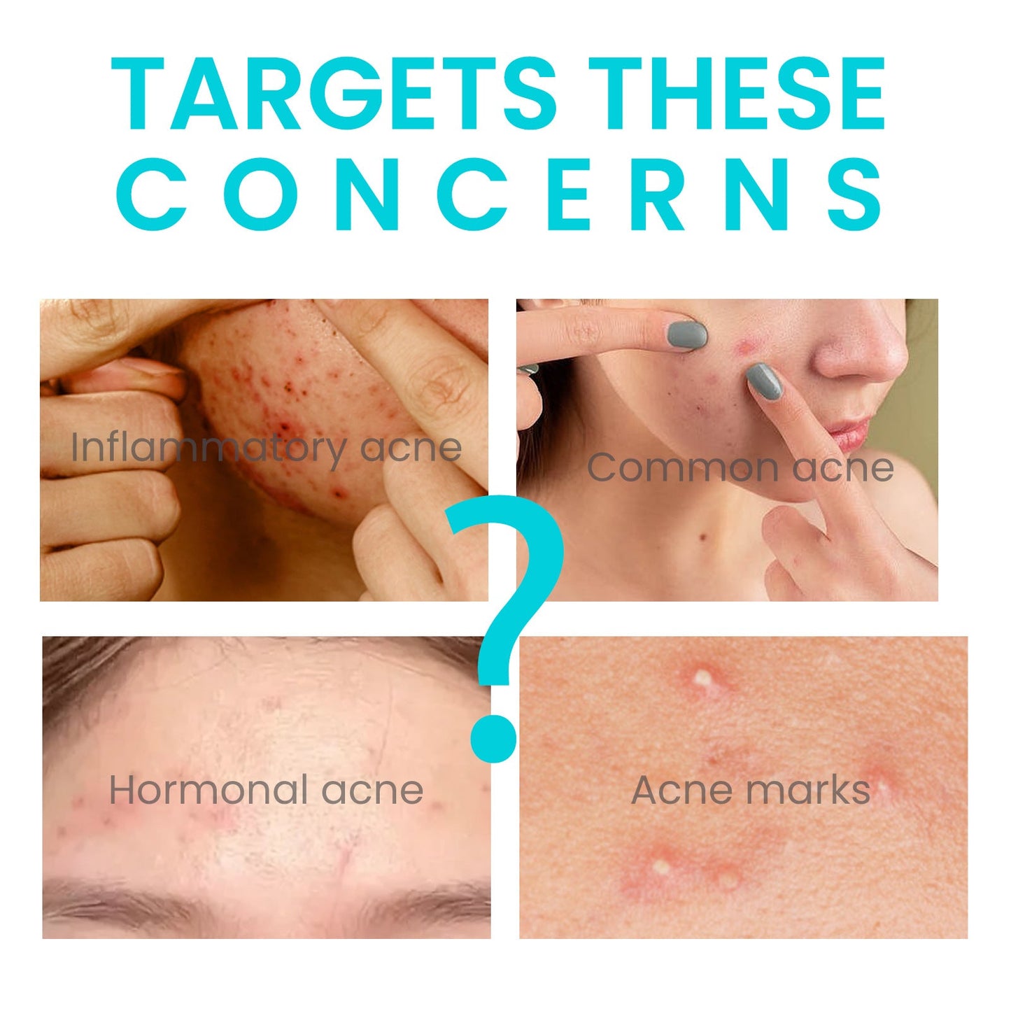 Jaysuing Brightening Acne Cream for Smooth Skin - Elite Nutrition